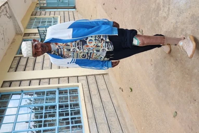 David Mwenda after receiving his new prosthesis